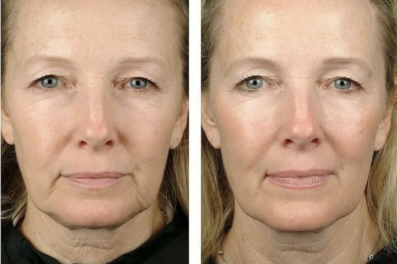 Fogmester Beauty Botox Budaörs kép